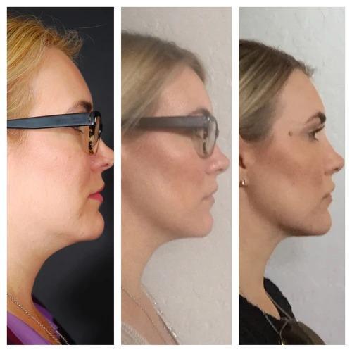Slimming Strap